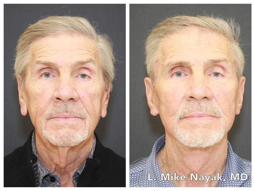 Blepharoplasty Before & After