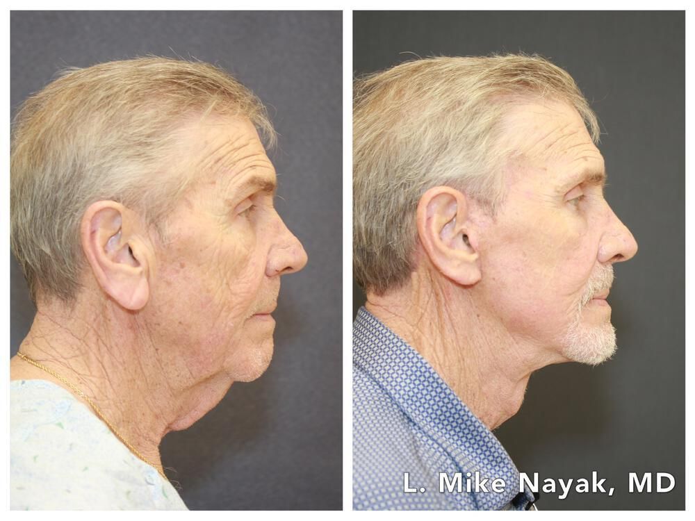 Blepharoplasty Before & After