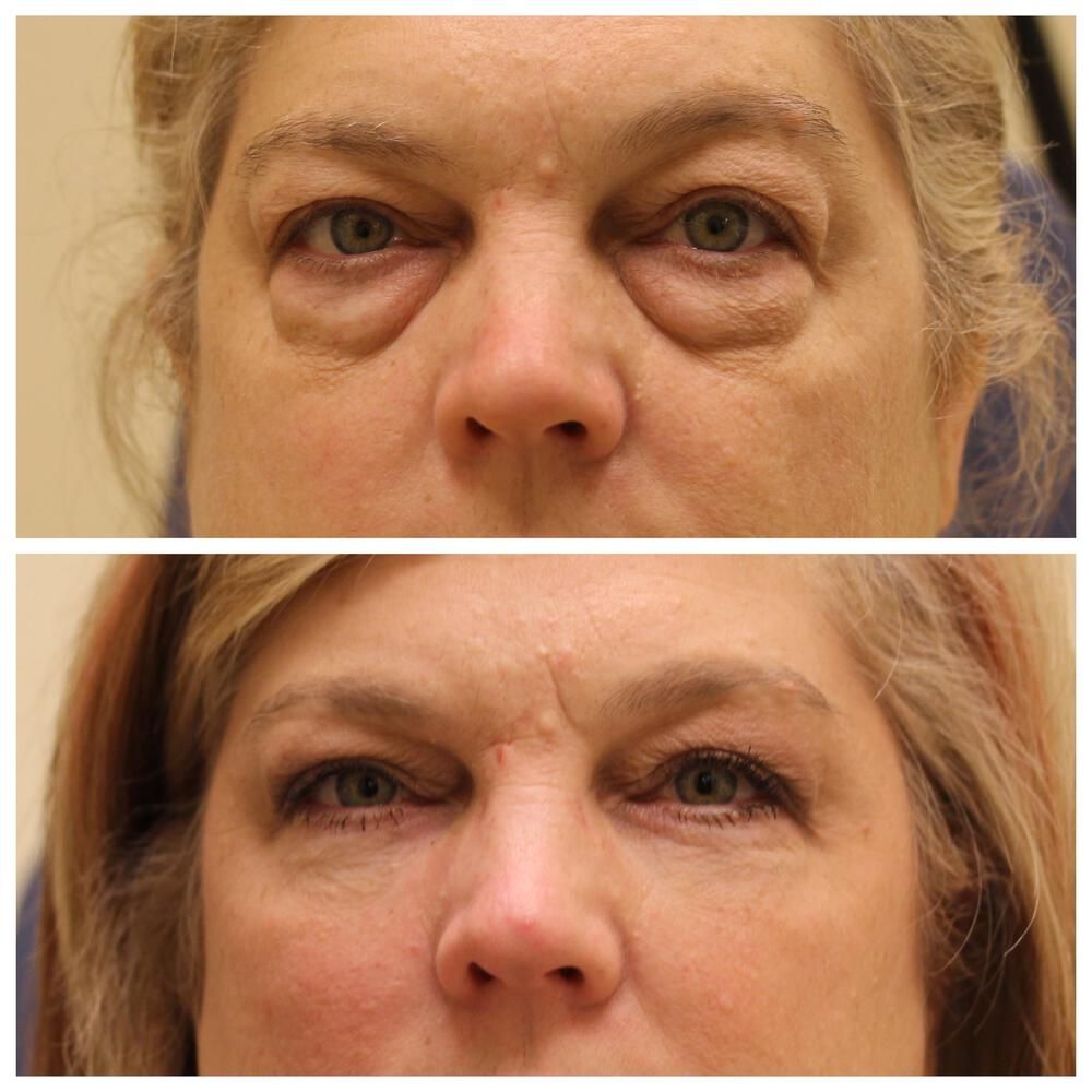 Blepharoplasty Before & After