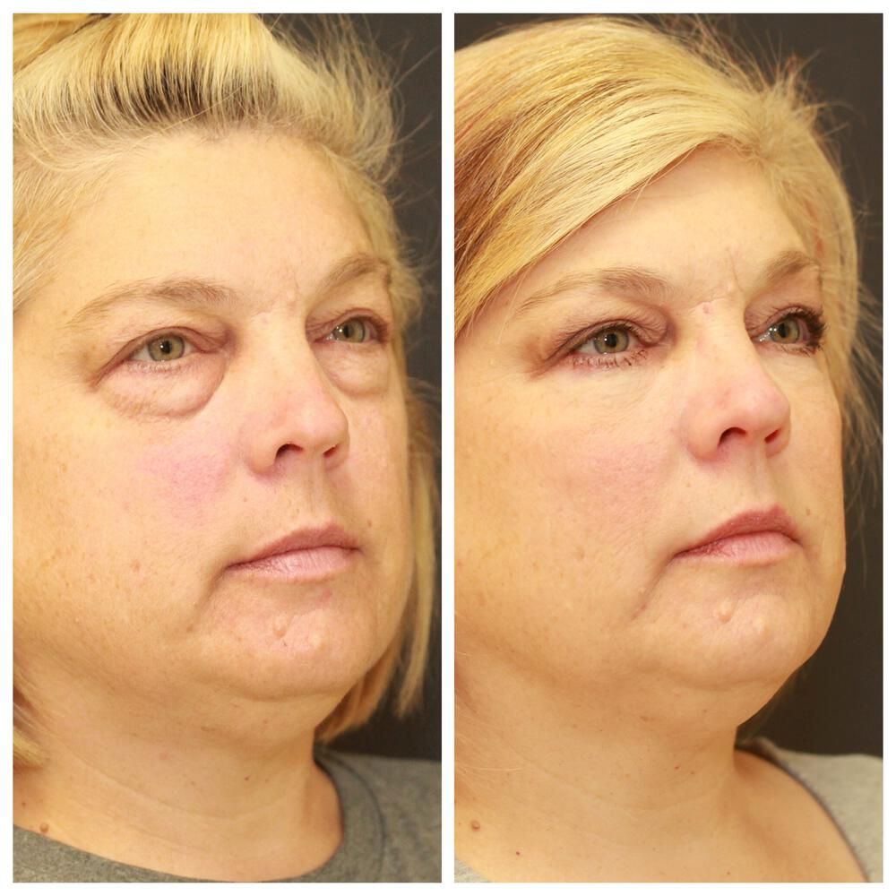 Blepharoplasty Before & After