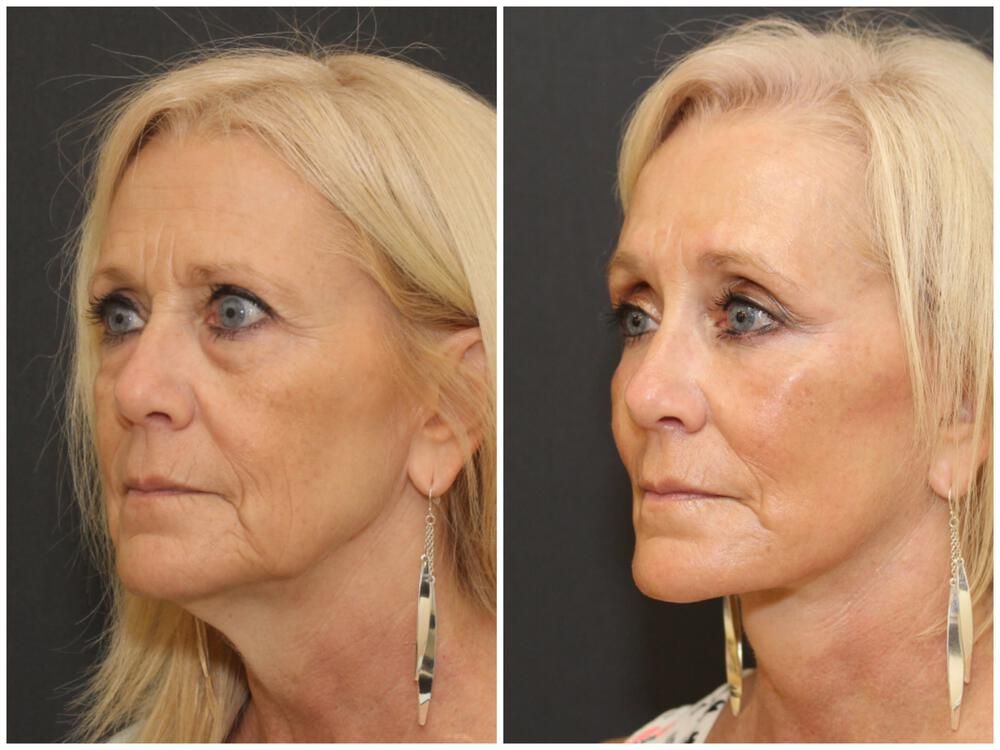 Blepharoplasty Before & After