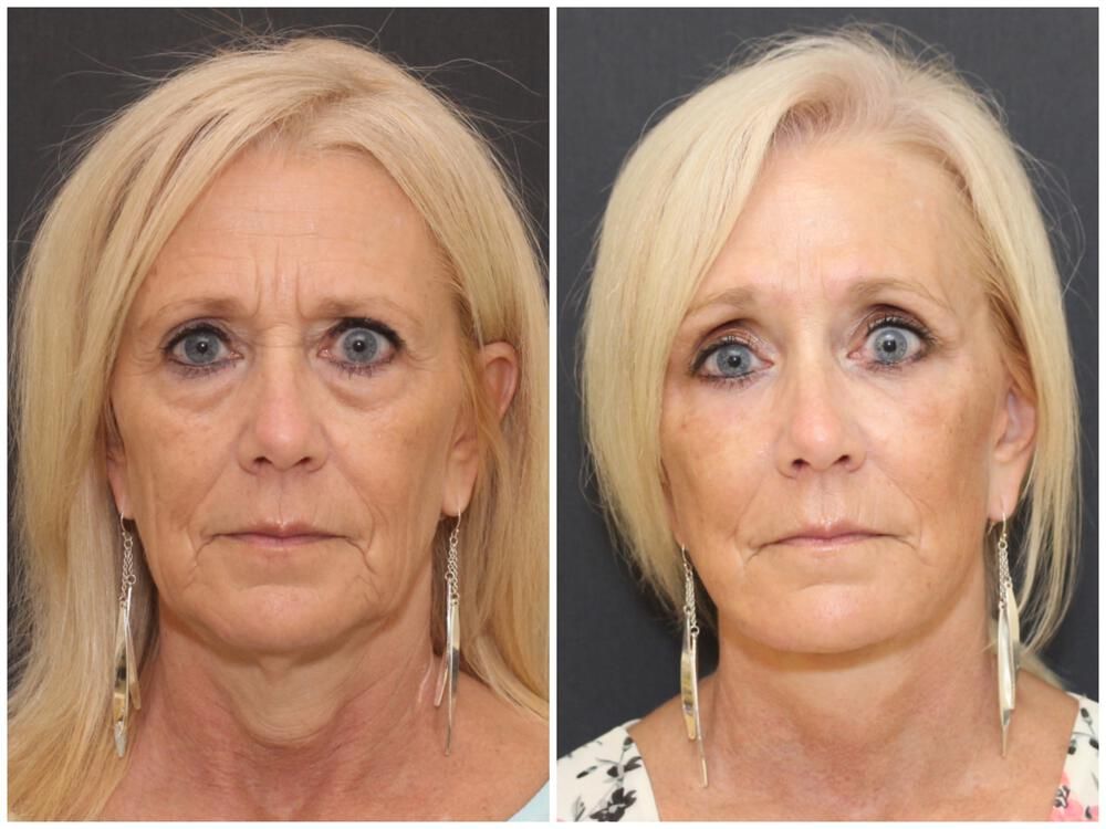 Blepharoplasty Before & After