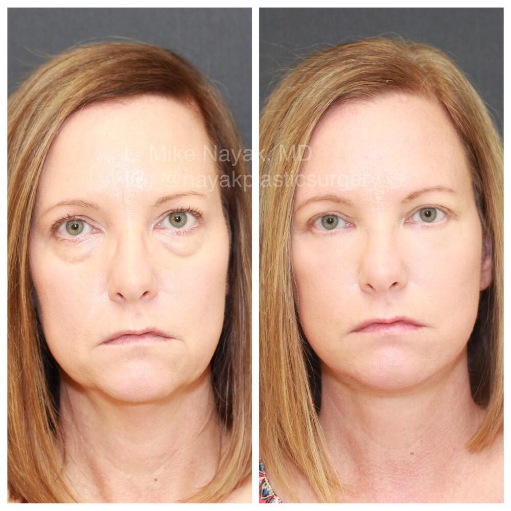 Blepharoplasty Before & After