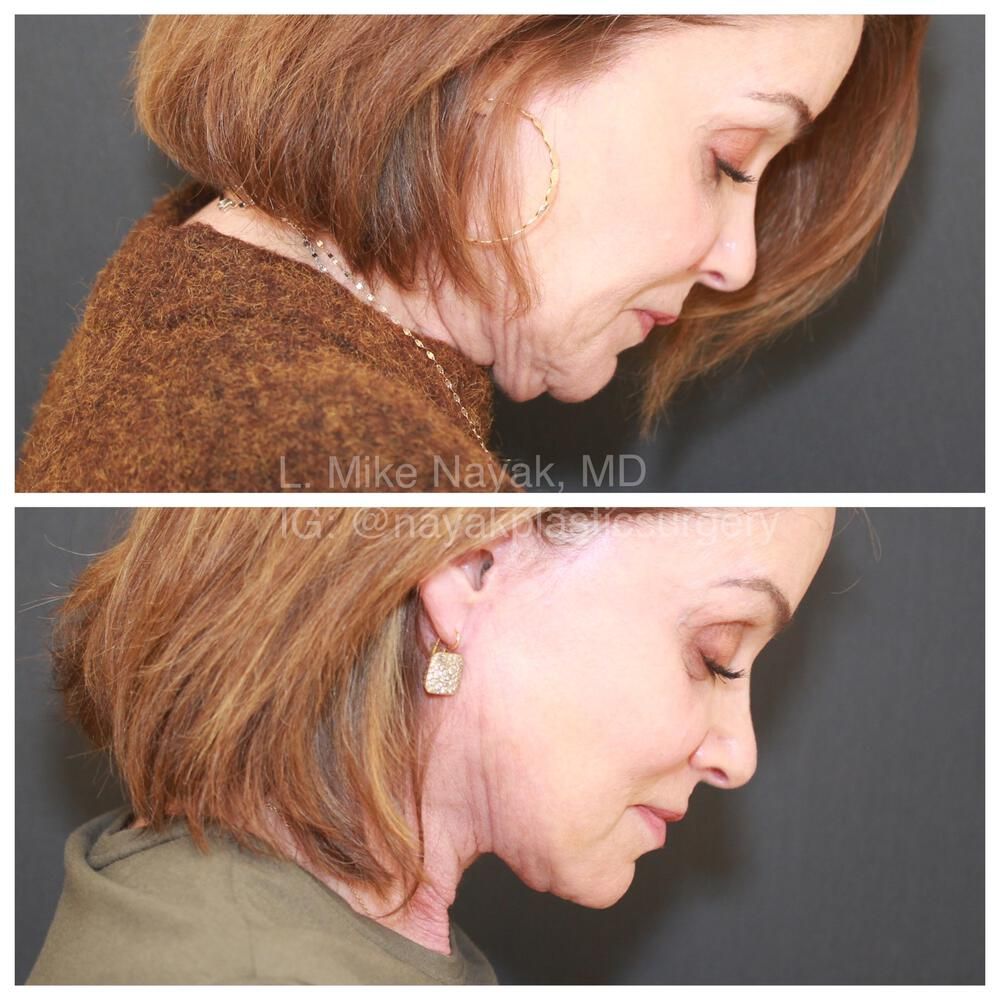 Blepharoplasty Before & After