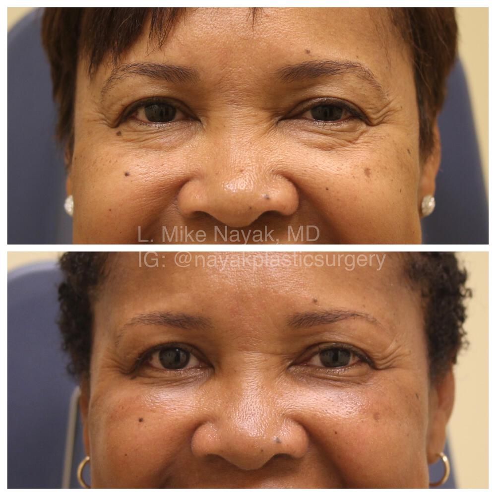 Blepharoplasty Before & After