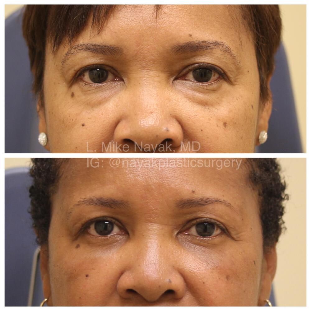 Blepharoplasty Before & After