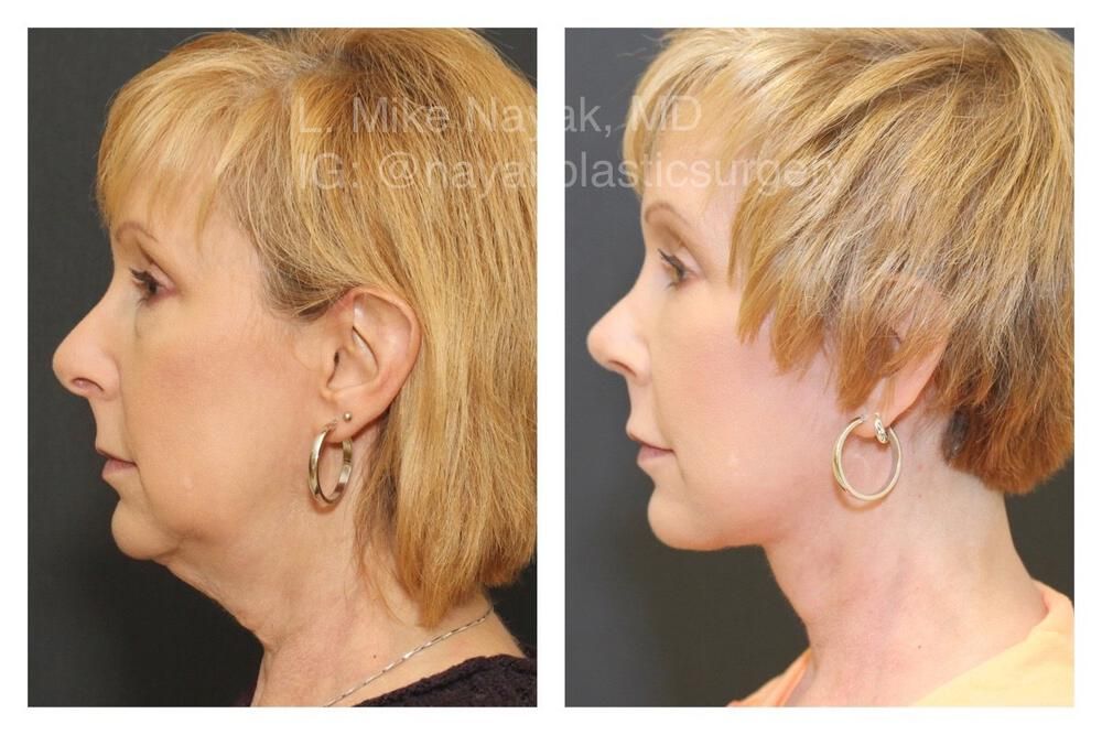Blepharoplasty Before & After