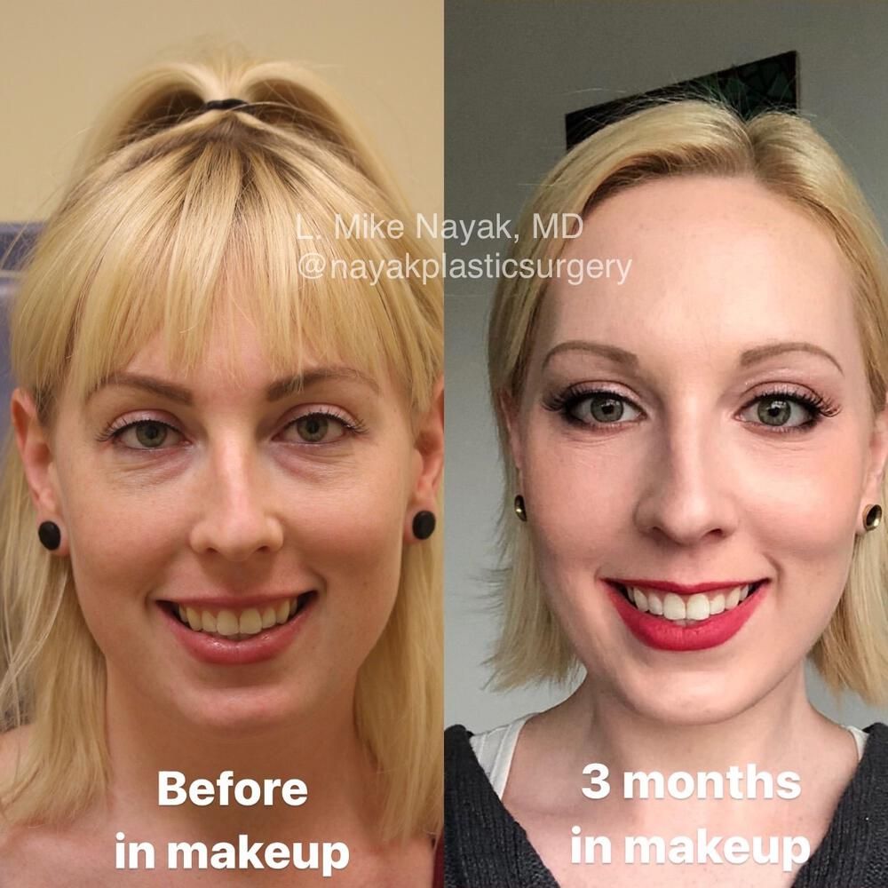 Blepharoplasty Before & After