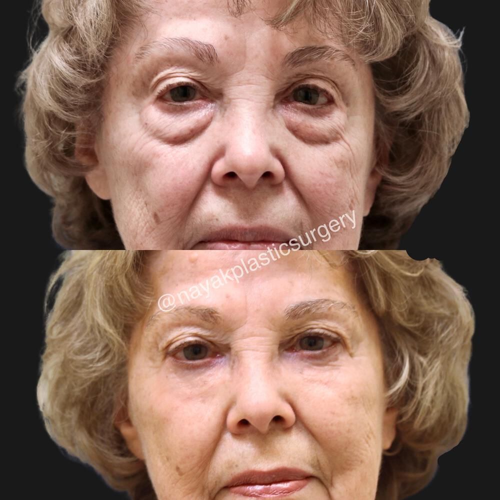 Blepharoplasty Before & After