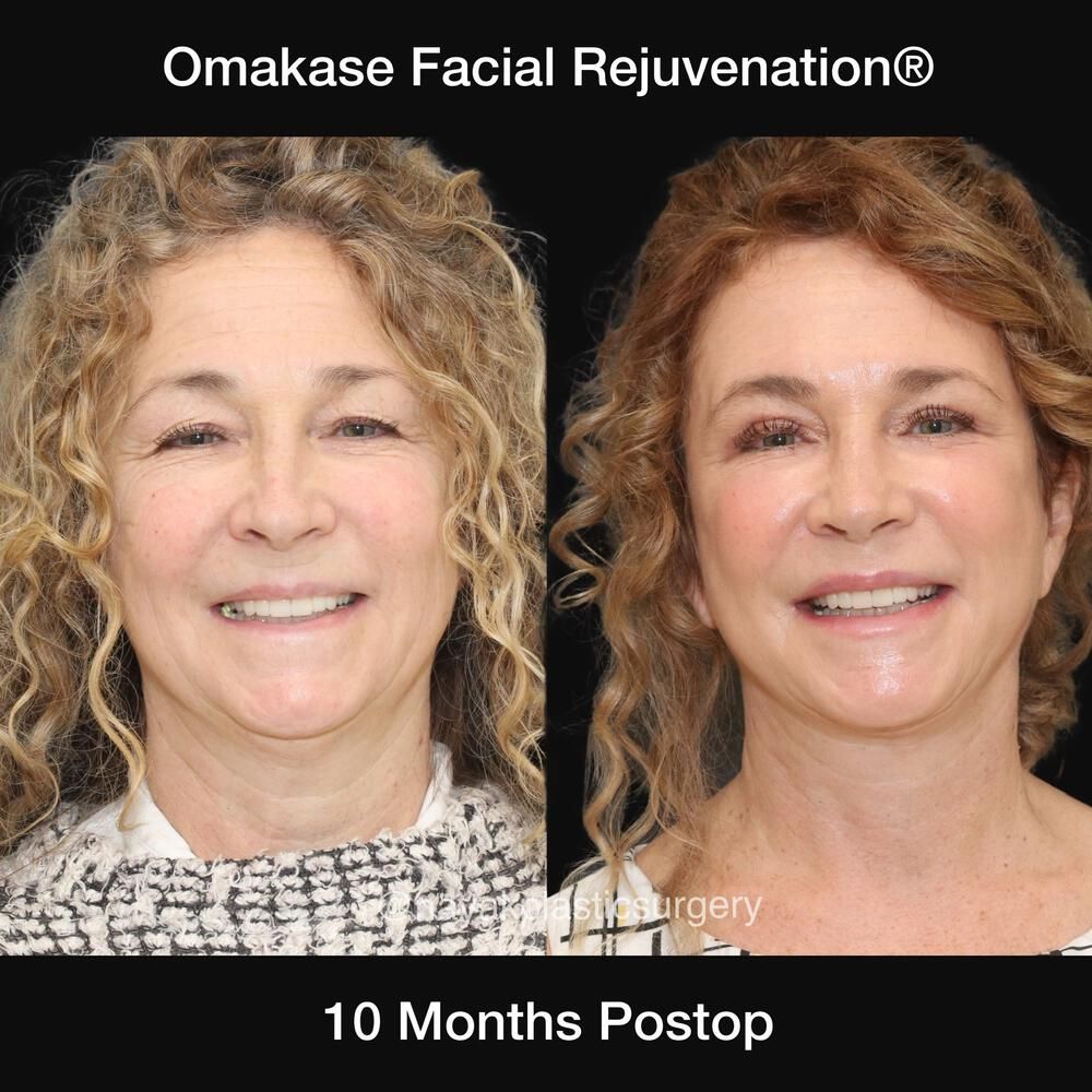 Blepharoplasty Before & After