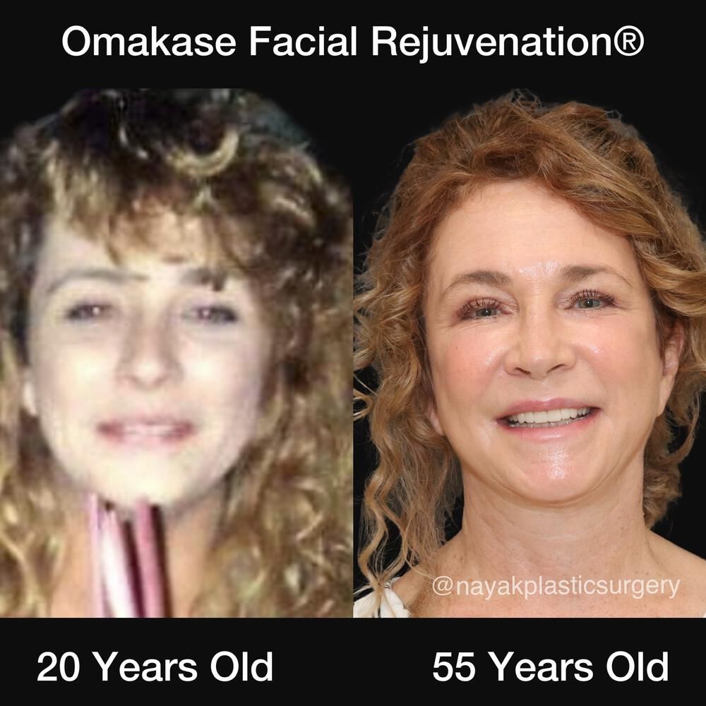 Blepharoplasty Before & After