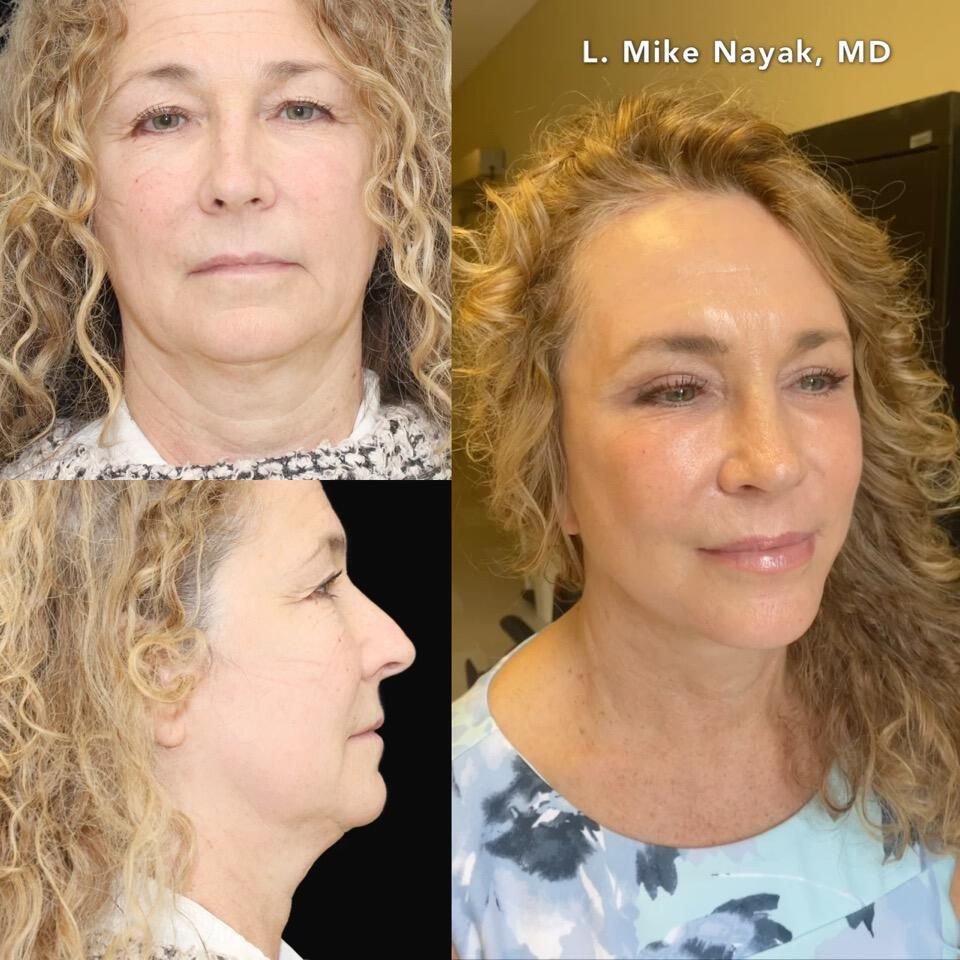 Blepharoplasty Before & After