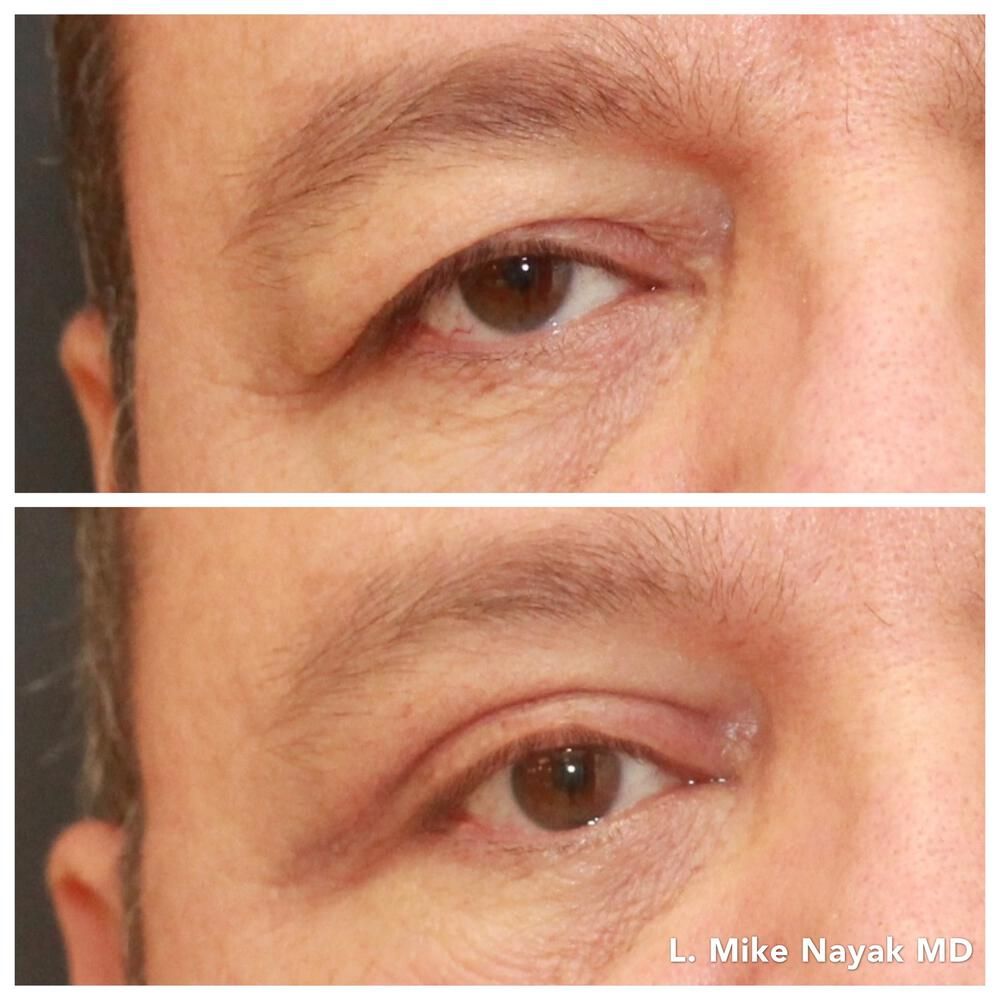 Blepharoplasty Before & After