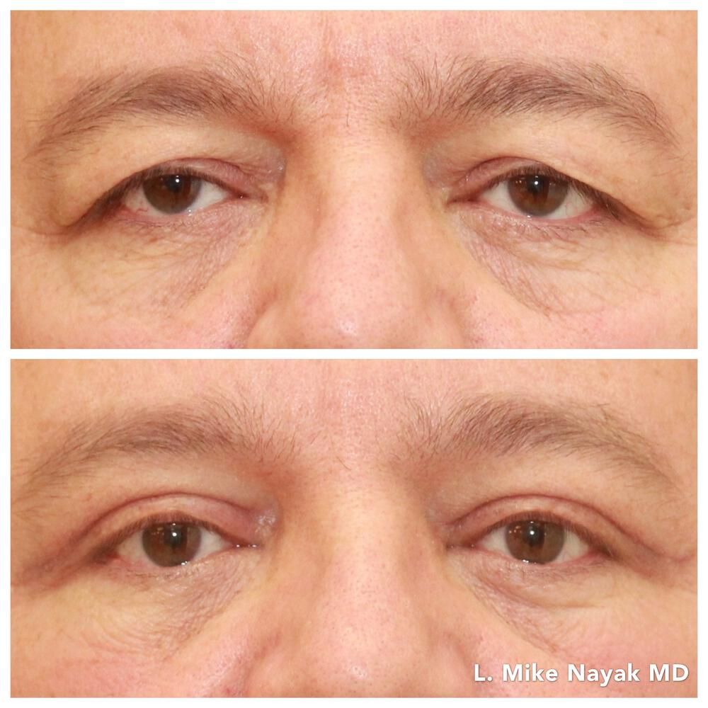 Blepharoplasty Before & After