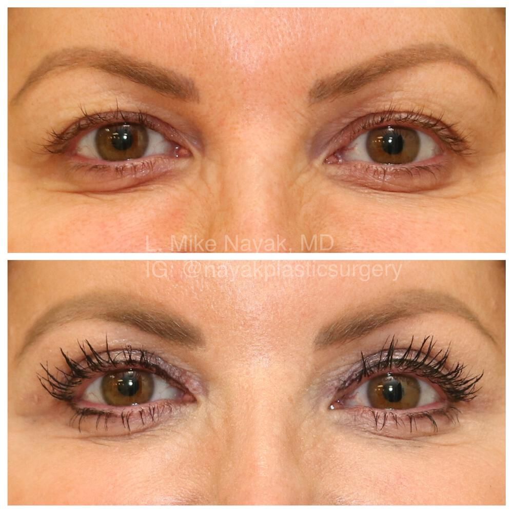 Blepharoplasty Before & After
