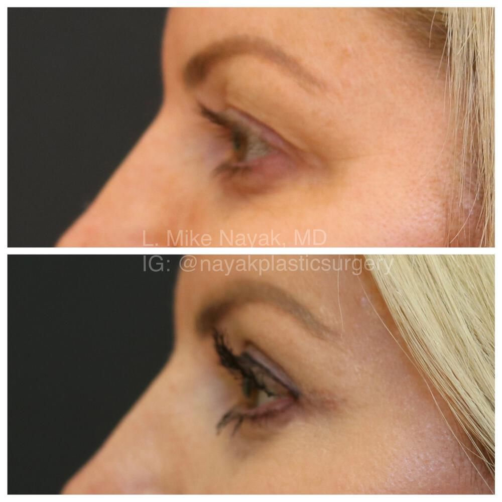Blepharoplasty Before & After