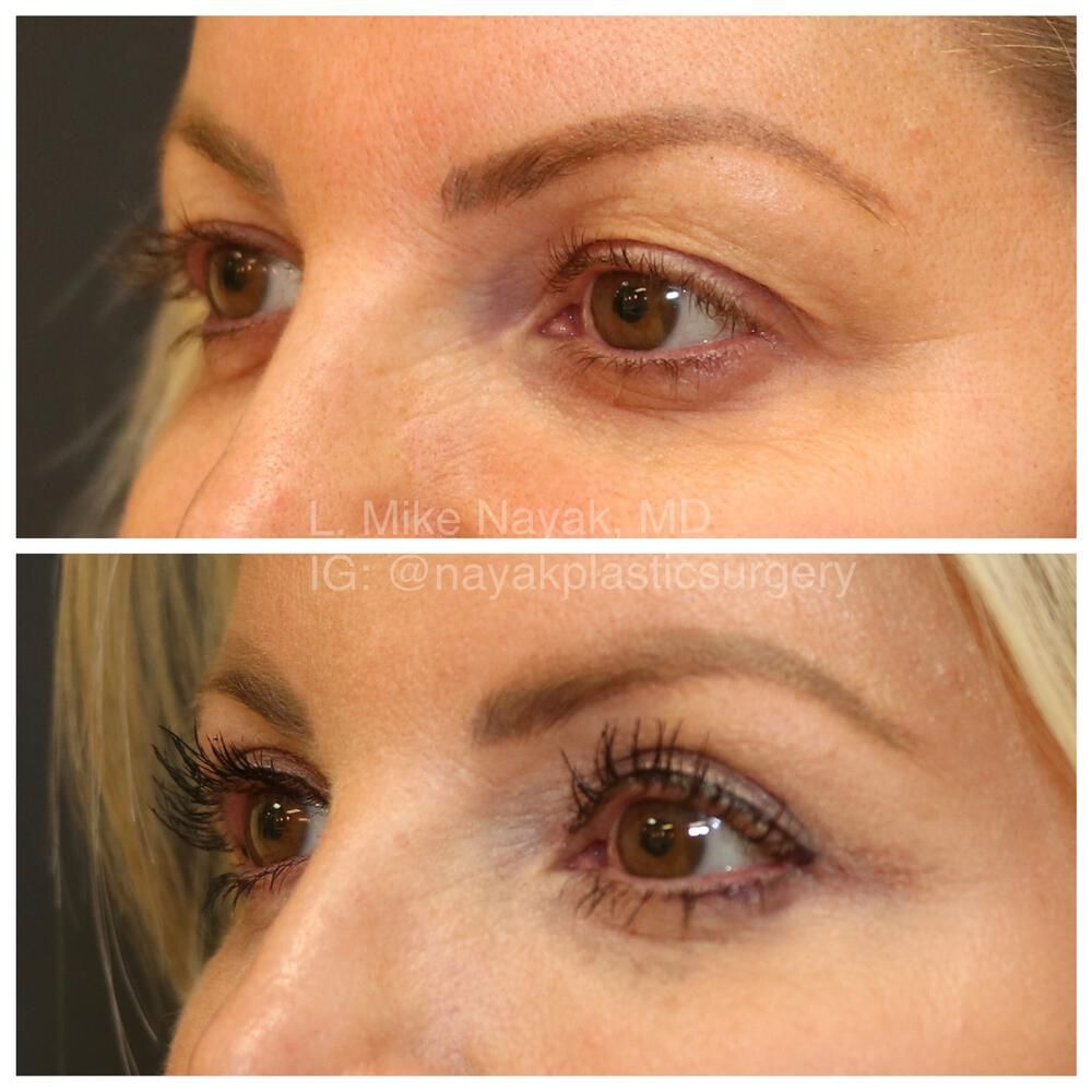 Blepharoplasty Before & After