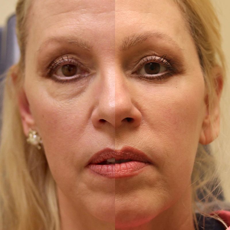Blepharoplasty Before & After