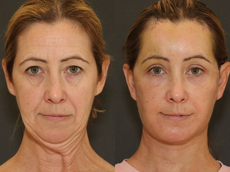 Blepharoplasty Before & After