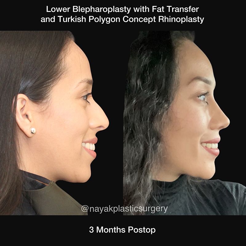 Blepharoplasty Before & After