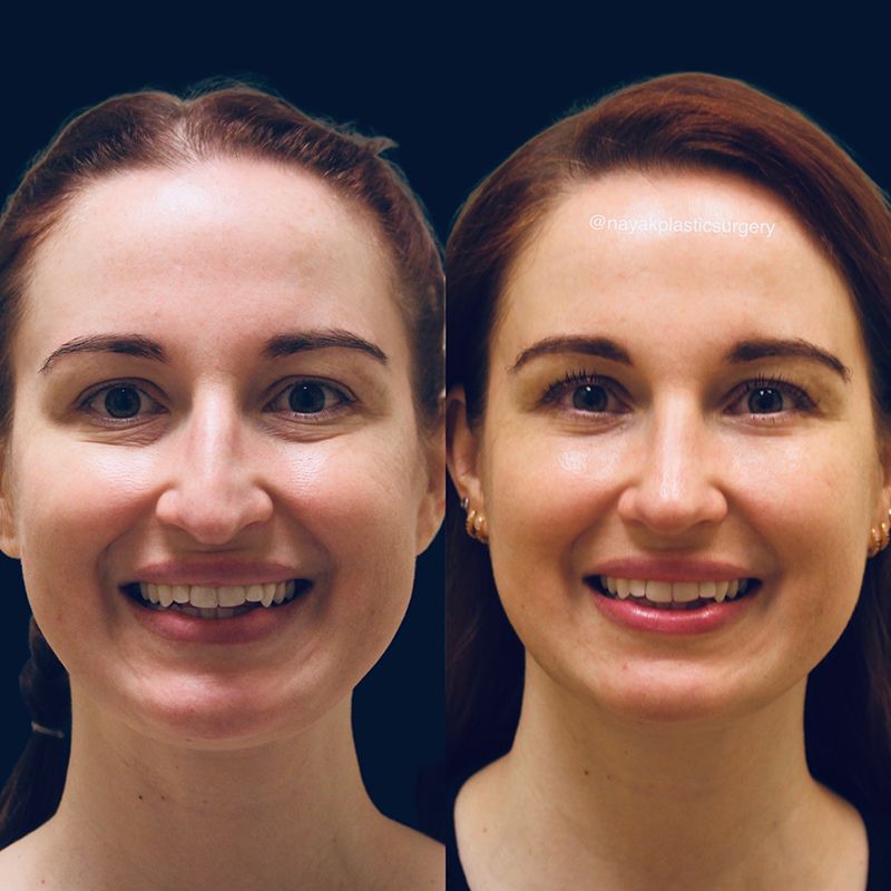 Blepharoplasty Before & After