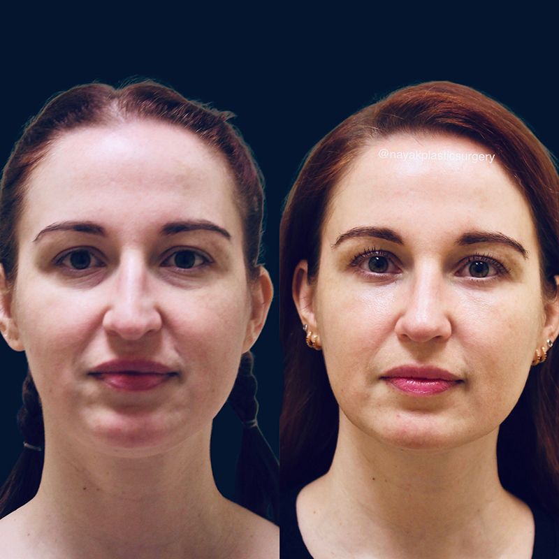 Blepharoplasty Before & After