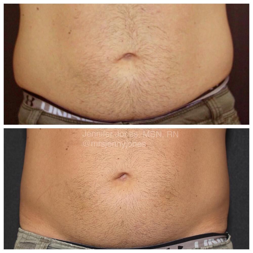Coolsculpting Before & After
